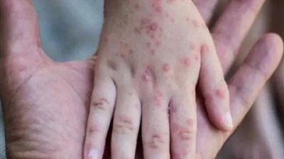 اجتماع في العاصمة عدن للاستعداد لمجابهة جدري القرود