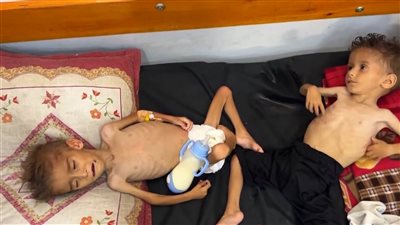 أربع وفيات جراء سوء التغذية في غزة خلال 24 ساعة